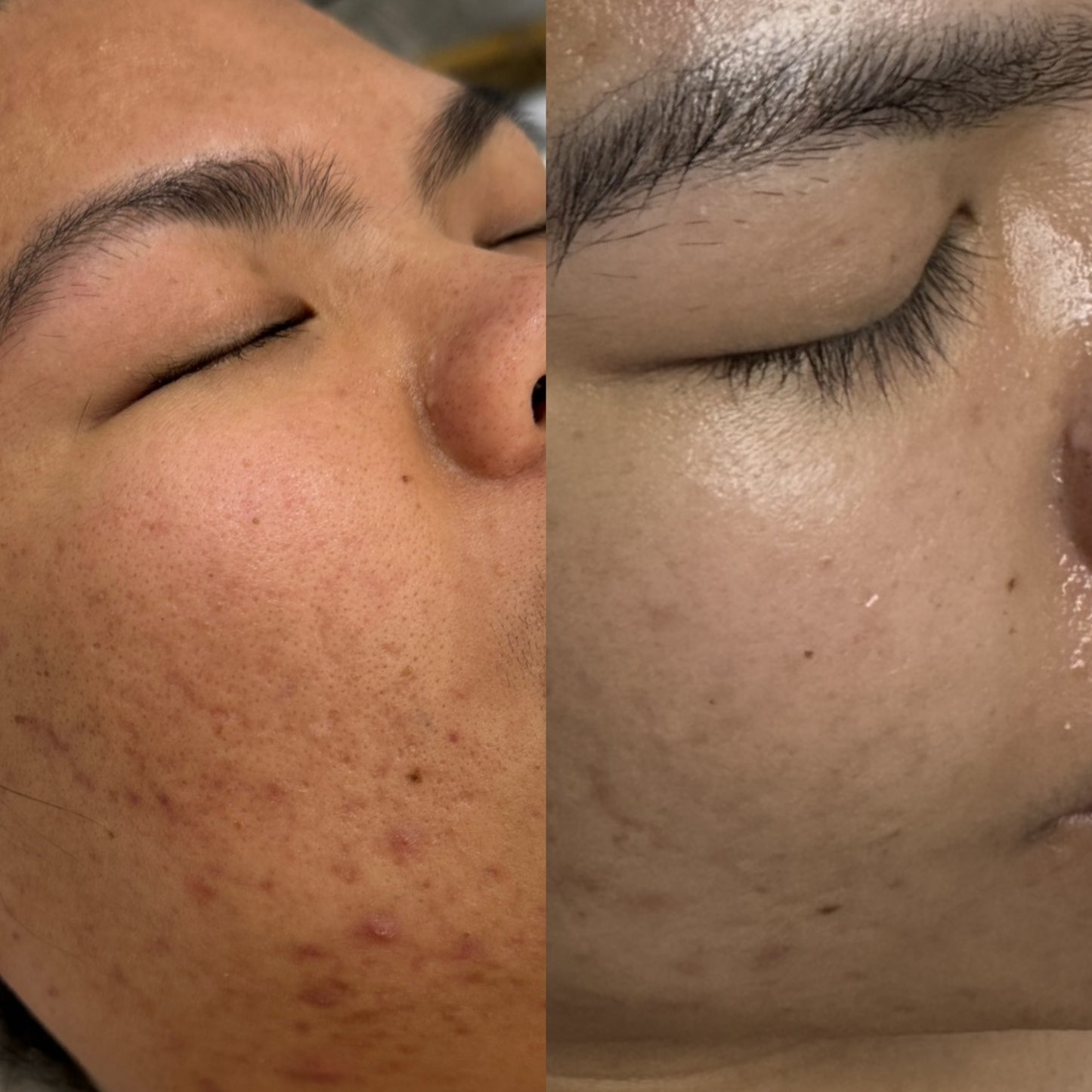 Acne Care Package