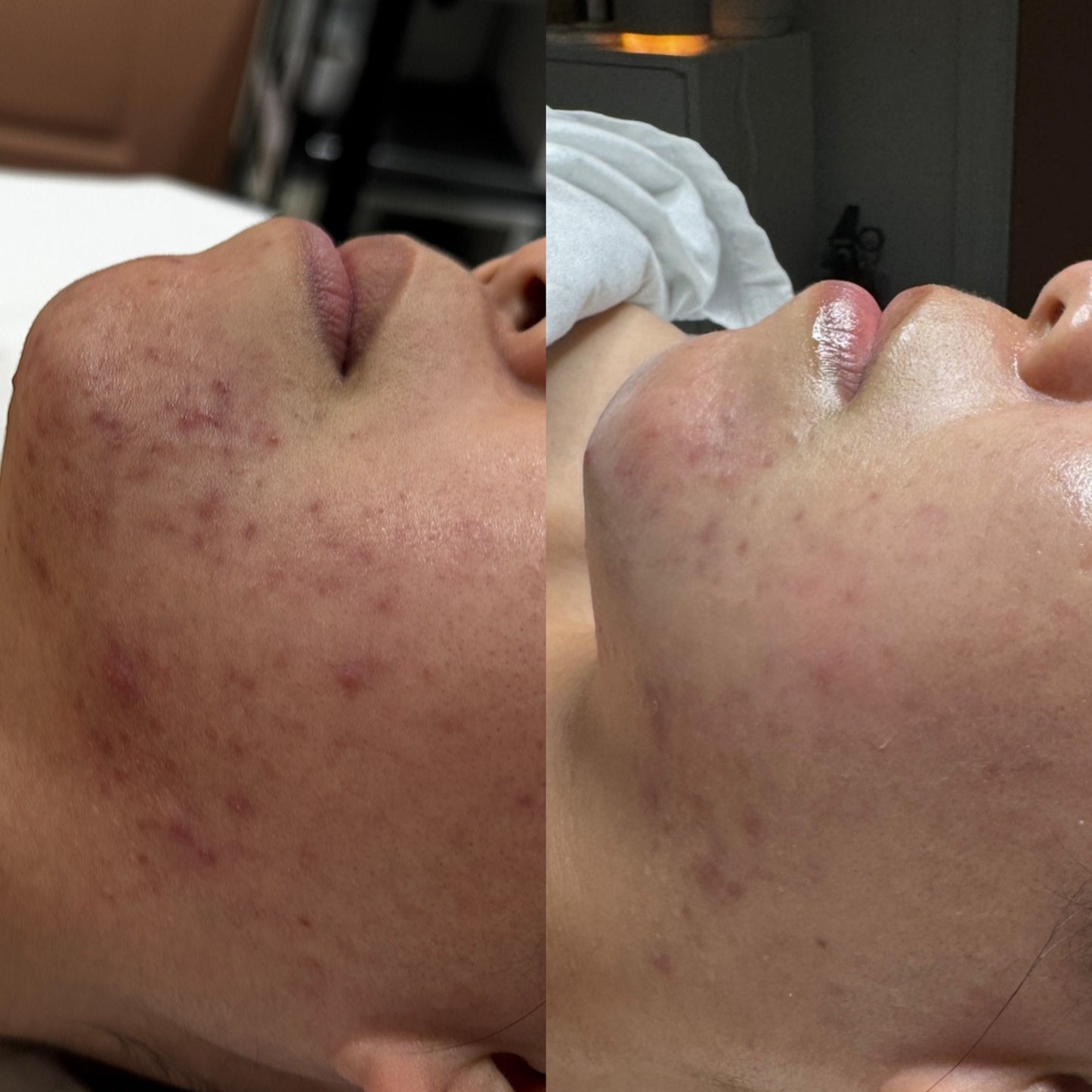 Acne Care Package