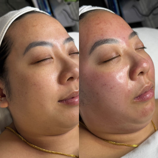 HIFU Lifting Program