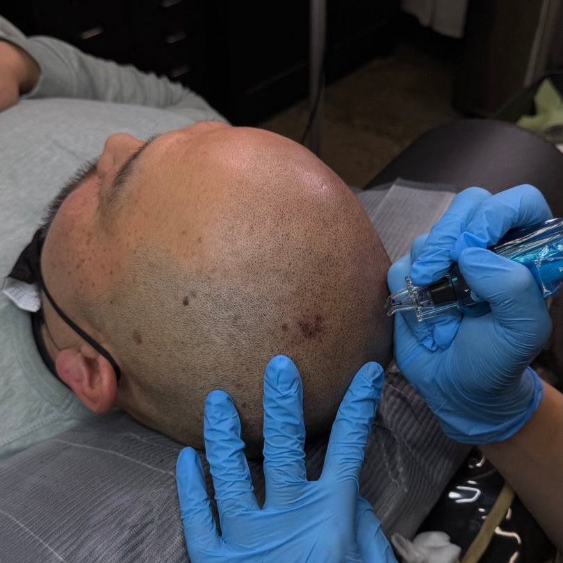 SMP(Scalp Micropigmentation)