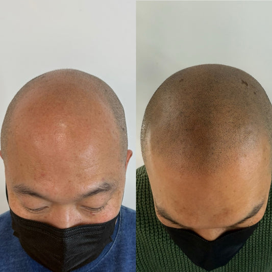 SMP(Scalp Micropigmentation)