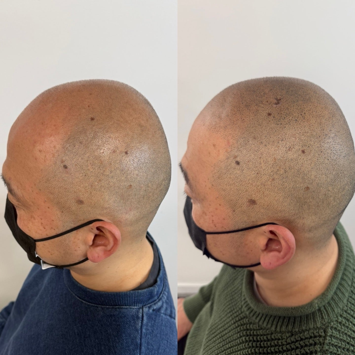 SMP(Scalp Micropigmentation)