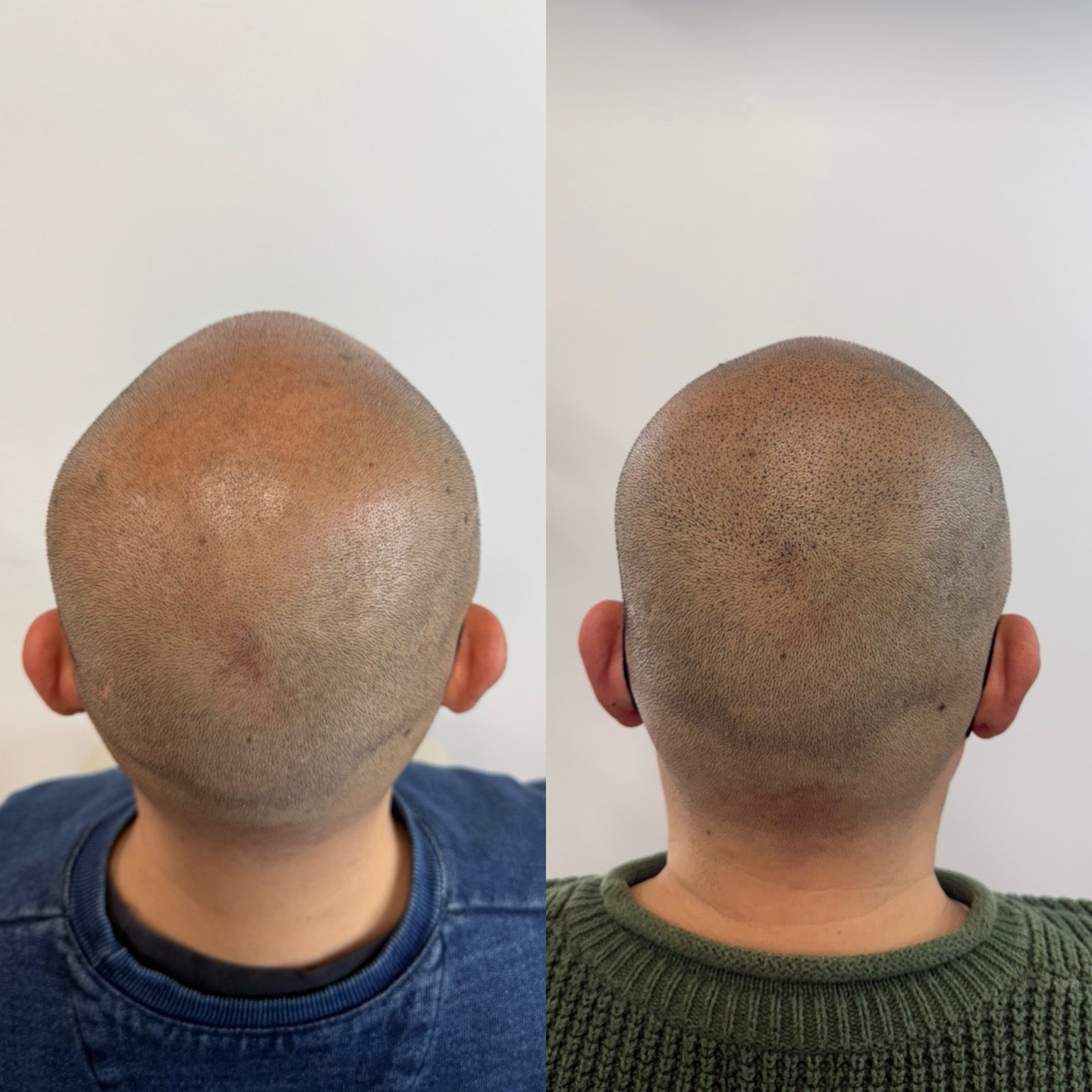 SMP(Scalp Micropigmentation)
