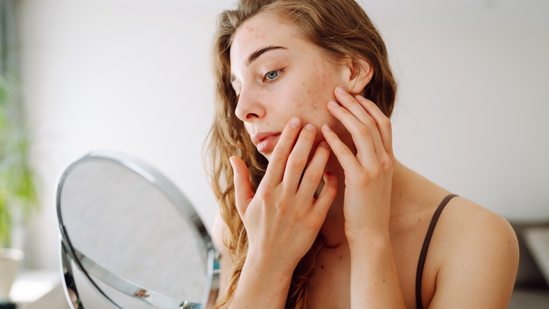 Signs Your Skin Barrier Is Damaged During Seasonal Weather Changes and How to Repair It Naturally