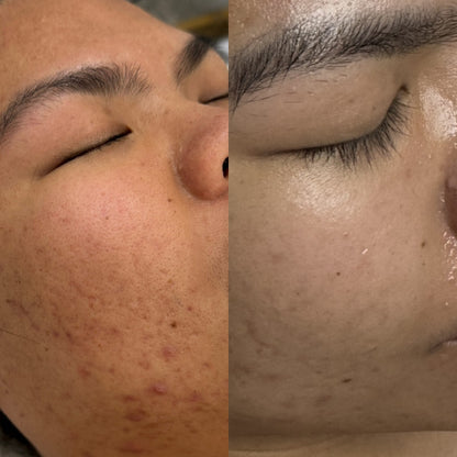 Acne Care Package